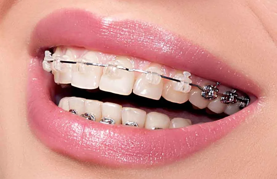 ارتودنسی چیست و چه کاربردهایی دارد؟